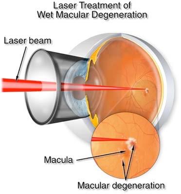 Age Related Macular Degeneration - Treatment Options | i2iOptic.mu