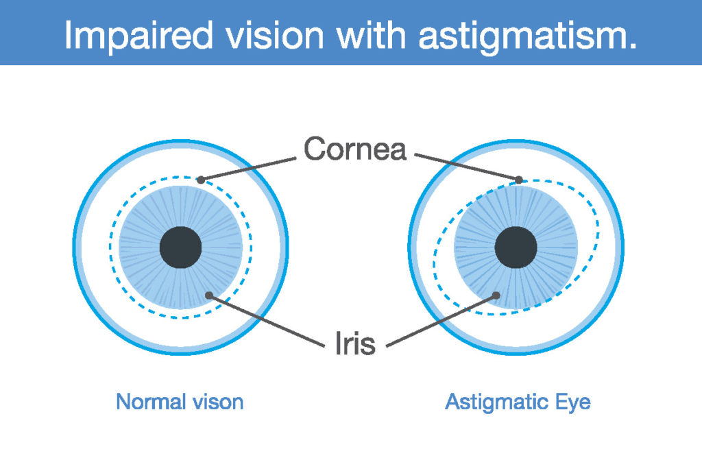 Simple And Compound Astigmatism